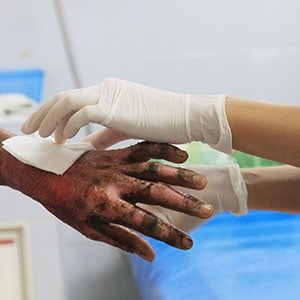 The worker's hand is burned - Leep Tescher Helfman and Zanze